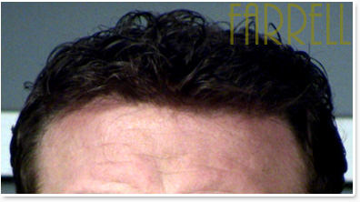 Hair Loss Hair Systems Orange County CA